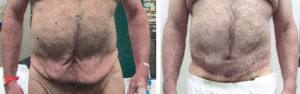 Male tummy tuck after weight loss