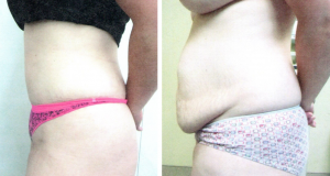 liposuction and abdominoplasty - 2