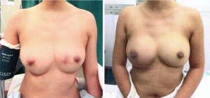 Bilateral nipple sparing simple mastectomies - Reconstruction with Gel Implants