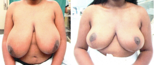 breast reduction 3     