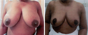 breast reduction 4 