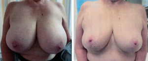 breast reduction 5    