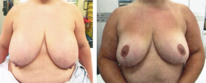 breast reduction1     