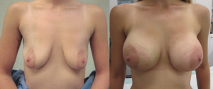 bilateral breast augmentation 2 