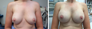 bilateral breast augmentation      